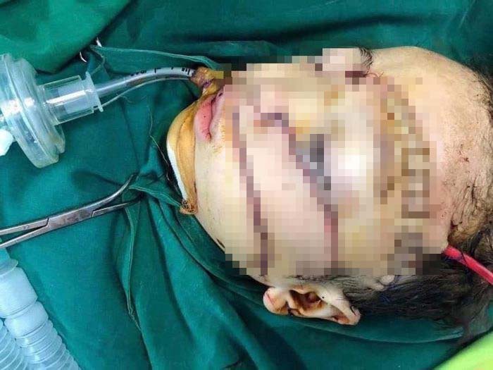 Đắk Lắk: Cháu bé 5 tuổi bị cha chém khâu gần 300 mũi nguy kịch - Ảnh 1. Đắk Lắk: Cháu bé 5 tuổi bị cha chém khâu gần 300 mũi nguy kịch - Ảnh 1.